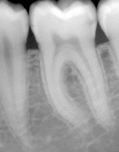 05. Het ontstaan van gaatjes en tandvleesontsteking