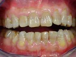 07. De kleur van tanden en kiezen