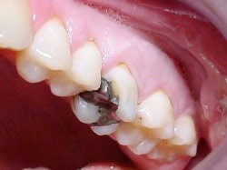 09. Vullingen in tanden en kiezen
