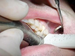 10. Vullingen in tanden en kiezen