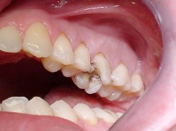 11. Vullingen in tanden en kiezen