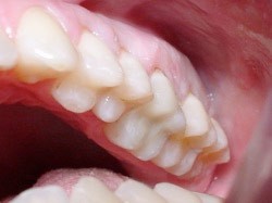 12. Vullingen in tanden en kiezen